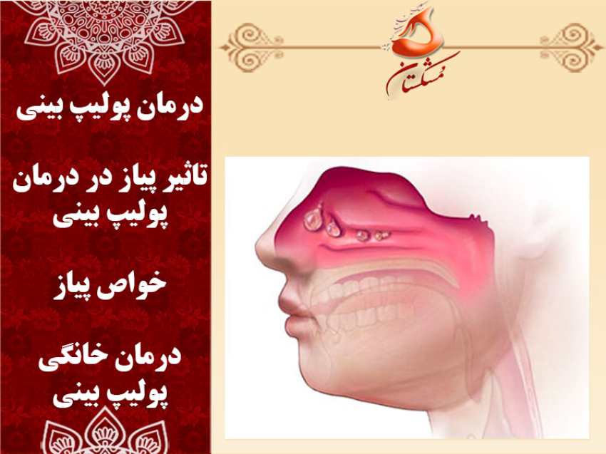 درمان پولیپ بینی